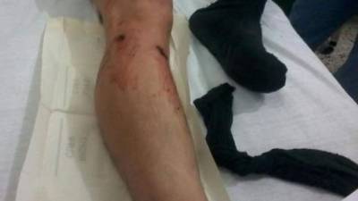 El subteniente Deybi Ayestas Olivera y el soldado Yoni Alexis Espinal Vásquez resultaron con heridas de bala