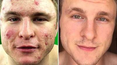 El joven de 23 años había probado todo tipo de remedios sin éxito.