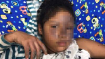 La niña fue ingresada al Hospital Escuela tras explotarle un petardo en el rostro.