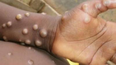 La Secretaría de Salud descartó la existencia de la enfermedad en el territorio hondureño.