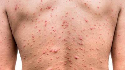 La especialista llamó a las autoridades de Salud a reforzar la vigilancia en los puntos fronterizos de Honduras.