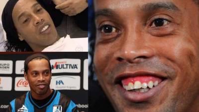 Ronaldinho lució en 2013 nuevo rostro. Invirtió 50 mil euros en una doble cirugía para cambiarse la dentadura. 'Me siento más seguro ahora. Me encanta pasar la lengua por los dientes y mirarme al espejo para comprobar el resultado', dijo.