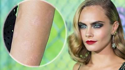 Una de las razones por las que Cara dejó el modelaje, fue la aparición de psoriasis.