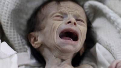 Las imágenes de Saha Dofdaa, una niña con un severo caso de desnutrición, expone los horrores que afectan a Siria, envuelto en una guerra civil desde el 2011 que ha costado más de 300,000 vidas, según estimaciones de organismos de Derechos Humanos.ADVERTENCIA: imágenes sensibles, se recomienda discreción.