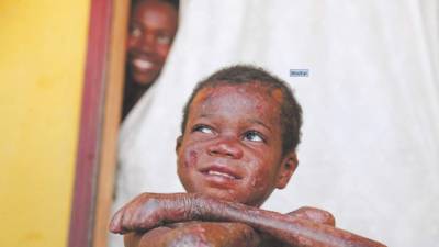 El pequeño Alexander Mauricio de 10 años es un verdadero guerrero que pese a su enfermedad lucha por su vida.