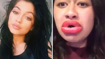 Lo preocupante al respecto es que no solo obtienen labios hinchados, además se generan hematomas alrededor de la boca.