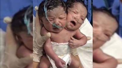 El bebé bicéfalo nació el 6 de enero en el estado de Chihuahua.