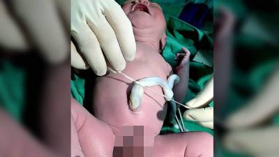 Personal del Seguro Social deja en evidencia las carencias de la institución al fotografiar a este recién nacido mientras le amarran el cordón umbilical con una cinta.