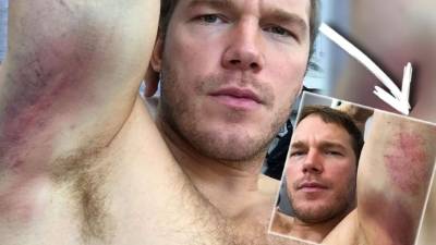 Chris Pratt mostrando las lesiones que sufrió en el rodaje de 'Passengers' (c) Instagram.