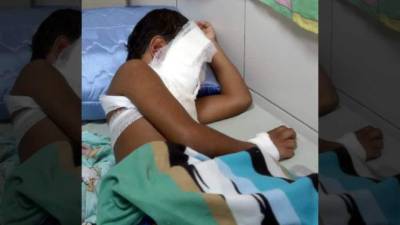 El menor está en la sala de quemados.