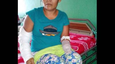 Rosa Vivian perdió su mano izquierda de un machetazo. Foto: Hrn