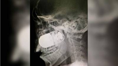 Fotografía cedida de la radiografía del rostro del soldado profesional del Ejército de Colombia Leandro José Luna, a quien se le incrustó una granada. EFE/Hospital Militar Colombia.