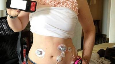 El páncreas artificial permitió a los pacientes mantener el nivel correcto de azúcar en la sangre.