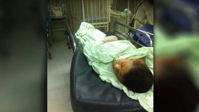 El menor sufrió las quemaduras y fracturas en su mano izquierda.