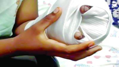 <b>Niño muestra su mano luego de ser sometido a cirugía debido a lesiones por manipular pólvora.</b>