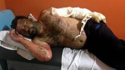El brasileño Flabio Agusto Gómez cuando fue ingresado en el Hospital de Tocoa, con graves quemaduras en su cuerpo.