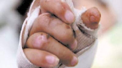 El niño Nelson Daniel Chacón, de seis años de edad, ingresó al HEU ayer.