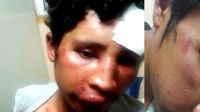 El hondureño Adrián se recupera en un hospital de México.