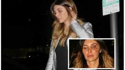 La modelo de la agencia Elite Model apareció en California con el ojo morado.