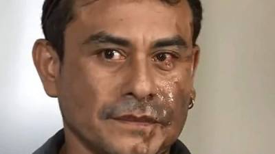 Mahud Villalaz sufrió graves quemaduras en su rostro tras ser atacado con ácido en Wisconsin./Twitter.