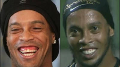 El antes y después de la intervención odontológica de Ronaldinho.