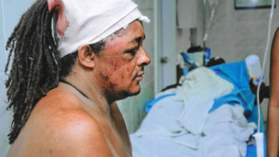 A survivor waits at the hospital at the hospital in El Progreso, Honduras after an accident on the road between El Progreso and Tela, some 220 km north of Tegucigalpa, on October 4, 2010. At least 14 people were killed and 11 were injured when the bus transporting music group 'Chicas Samba' crashed and caught fire. AFP PHOTO / STR