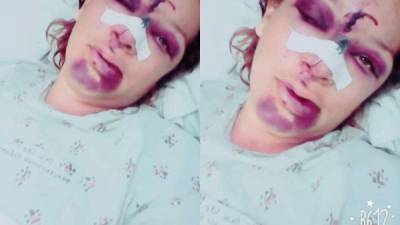 Haydi Julisa Rivera Lara (30) relató que ha sido golpeada anteriormente unas 20 veces por su pareja.