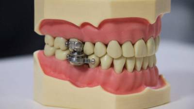 Dispositivo magnético desarrollado en Nueva Zelanda, llamado DentalSlim Diet Control.