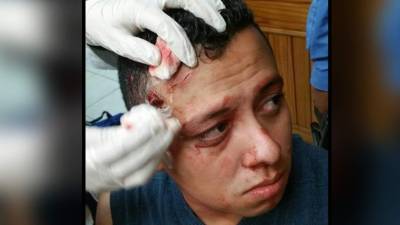 Ramsés Urrutia recibió el impacto de un vaso de vidrio en su rostro.