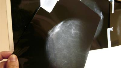 La ONU calcula que el cáncer aumentará a 22 millones de casos anualesUna prueba radiológica de mama. EFE/Archivo