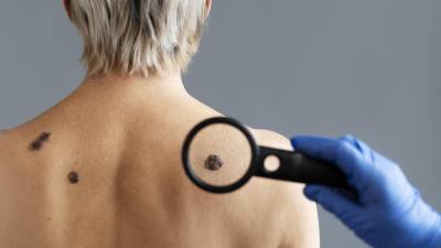 Cuidado. Este tipo de lunares pueden ser un indicador de cáncer.