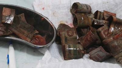 Los médicos extrajeron decenas de billetes de 100 dólares del estómago de la mujer.