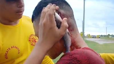 Joven hondureño termina con un pez incrustado en la cabeza