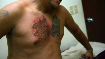 Luego de 27 minutos y 3,966 disparos láser, el primer tatuaje del pecho es removido y para concluir el procedimiento.