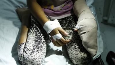 Más de 10 menores ingresaron en Navidad a los hospitales Mario Rivas y el Escuela por quemaduras por pólvora.