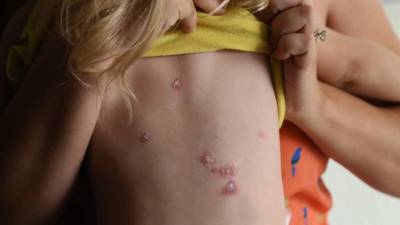 Alejandra Castillo es una niña que padece la enfermedad y los padres no sabían que podía ser grave hasta que llegaron a la consulta. Ella no se curaba con tratamientos tradicionales.