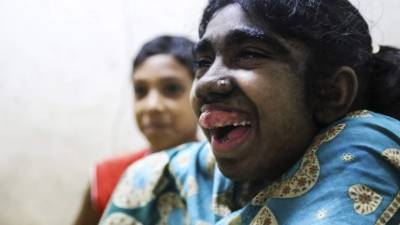 Solo cuatro o cinco personas en el mundo sufren la misma condición de Bithi Razzak. Foto: EFE/Igor G. Barbero