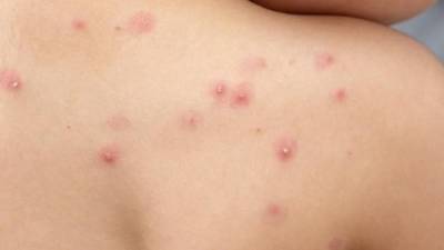 Esta enfermedad data de, al menos, 40 años y es endémica de los países de África. Imagen referencial de archivo.