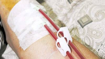 Las personas que se dializan aseguran que el dolor es permanente durante todo el procedimiento.