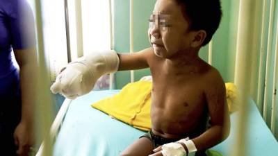 El pequeño de cuatro años ingreso el lunes al hospital y se le amputaron dos dedos porque no eran rescatables.