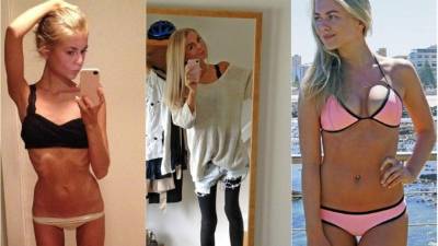 Amalie Lee tomó la decisión no ser “la chica anoréxica” y a sus 20 años libra una batalla contra la mortal enfermedad publicando su experiencia en Instragram.
