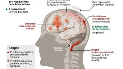 Infografía de la lesión de Michael Schumacher.