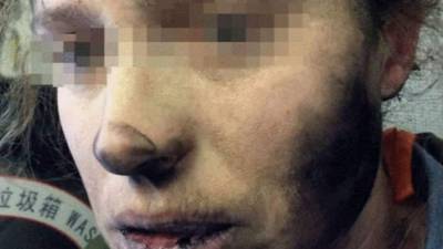 Las imágenes muestran que la víctima quedó con la cara y con el cuello ennegrecidos y con ampollas en las manos.