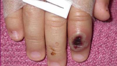Un dedo de un niño infectado por la “viruela de mono”.