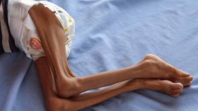 Más de cinco millones de niños están amenazados de hambruna en Yemen, denunció el miércoles la ONG Save the Children, en un contexto de guerra y de precios cada vez mas altos de alimentos y carburantes.