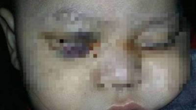 El pequeño Fernando Jonathan Valdés, tras la intervención.