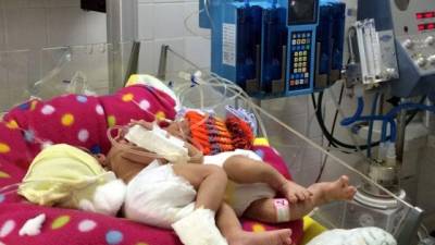 Las siamesas que nacieron en el hospital Mario Rivas de San Pedro Sula, cumplen hoy una semana de vida.