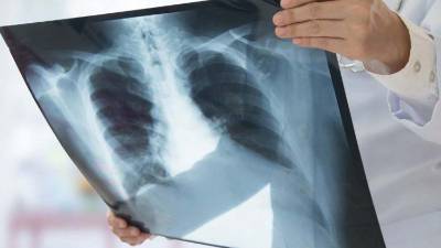 La pandemia de covid 19 contribuyó a un aumento de las muertes por tuberculosis, según estudio.