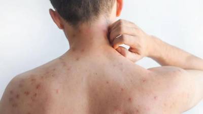 Las autoridades de salud insistieron en que la <b>vacunación</b> continúa siendo la medida más eficaz para prevenir contagios. Imagen referencial.
