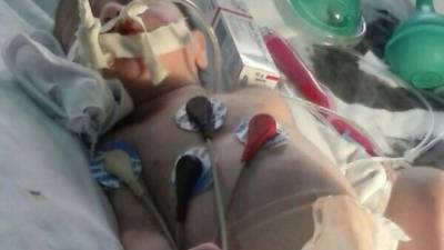 Falleció la bebé prematura que sufrió quemaduras de segundo grado en su cuerpo tras carle una lampara en el hospital Mario Catarino Rivas de San Pedro Sula.